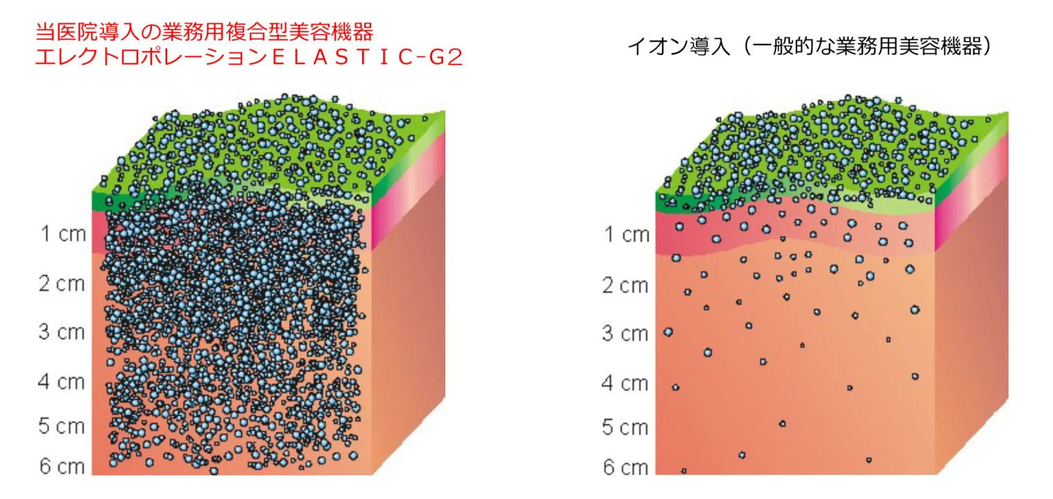 当医院導入のエレクトロポレーション（ELASTIC-G2）と一般的なイオン導入の比較。エレクトロポレーションは美容成分が皮膚の深くまで多く浸透する