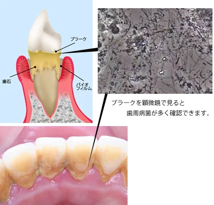 歯に付いたプラークと歯石のイラスト、顕微鏡で見たプラーク中の歯周病菌、プラークが付いた歯の写真