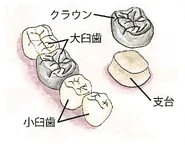 金属のクラウンと支台のイラスト