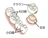 白いクラウンと支台のイラスト