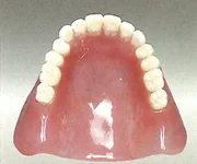 熱可塑性義歯（アクリJ）
