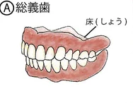 Ⓐ総義歯のイラスト