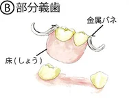 Ⓑ部分義歯のイラスト